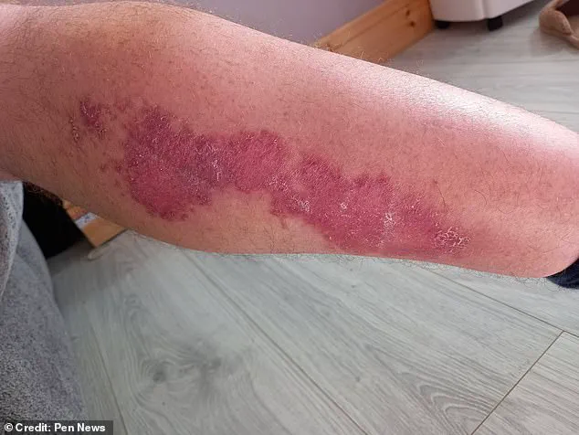 Urgent Alert: Window Cleaner Hospitalized After 'Britain's Most Dangerous Spider' Bite Sparks Renewed Safety Concerns in UK