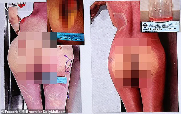 California Injector Convicted in Death Linked to Unregulated Silicone Injections