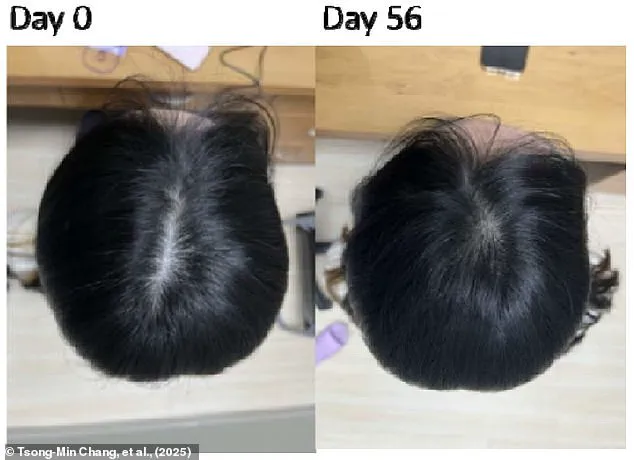 Late-Breaking Hair Loss Breakthrough: Taiwan Researchers Develop Safe Serum with Two-Month Success Rate