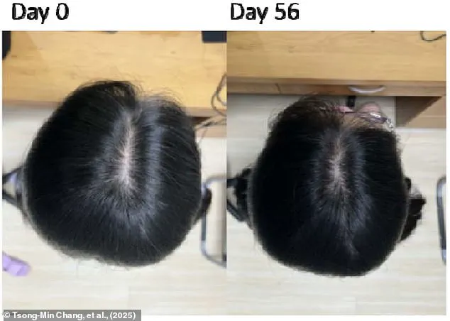 Late-Breaking Hair Loss Breakthrough: Taiwan Researchers Develop Safe Serum with Two-Month Success Rate
