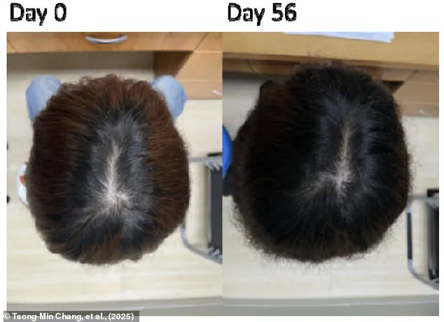 Late-Breaking Hair Loss Breakthrough: Taiwan Researchers Develop Safe Serum with Two-Month Success Rate