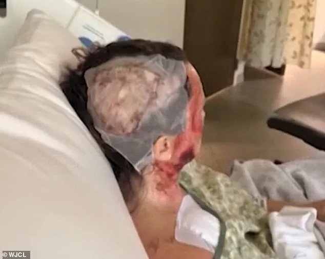 Brutal Acid Attack Leaves Georgia Woman Disfigured, Facing Millions in Medical Bills