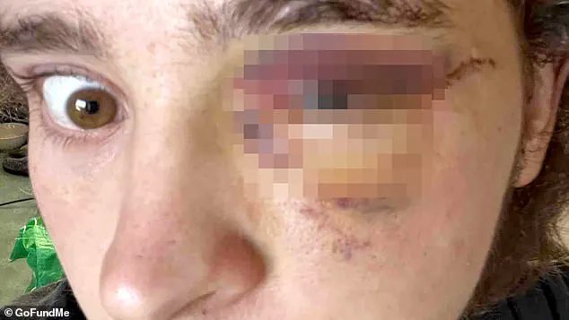 Projectile Strike During Protest Leaves 21-Year-Old With Permanent Vision Loss, Sparking Debate Over Law Enforcement Use Of Force