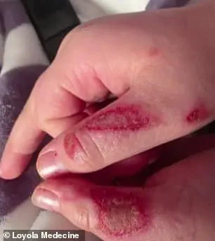 Nine-Year-Old's Severe Burns From Microwaving Sensory Toy in TikTok Trend