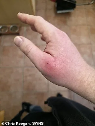 Coventry Man's Spider Bite Turns into Life-Threatening Infection, Highlighting Rise of False Widow Spiders in UK