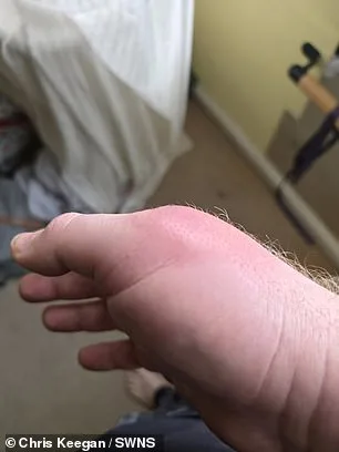 Coventry Man's Spider Bite Turns into Life-Threatening Infection, Highlighting Rise of False Widow Spiders in UK