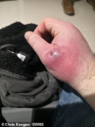 Coventry Man's Spider Bite Turns into Life-Threatening Infection, Highlighting Rise of False Widow Spiders in UK