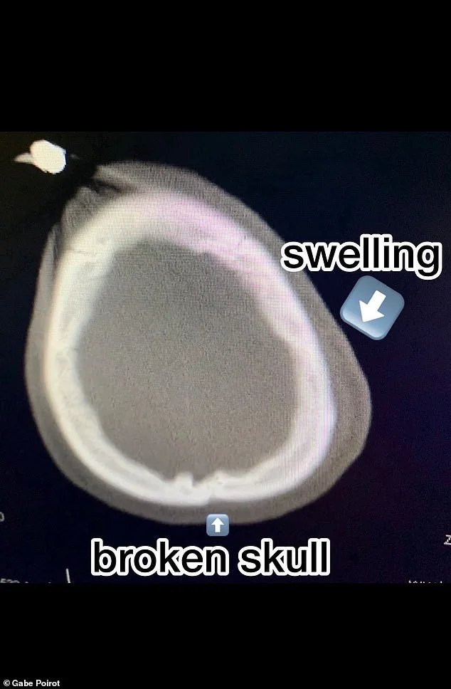 Miraculous Survival After Skateboard Accident Leaves Man with 99% Brain Stem Damage