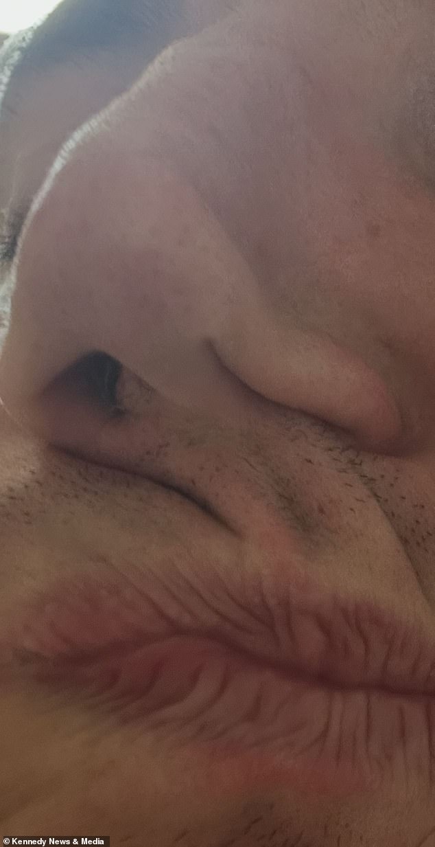 Years of Cocaine Use Leaves Failsworth Father With Permanently Disfigured Face