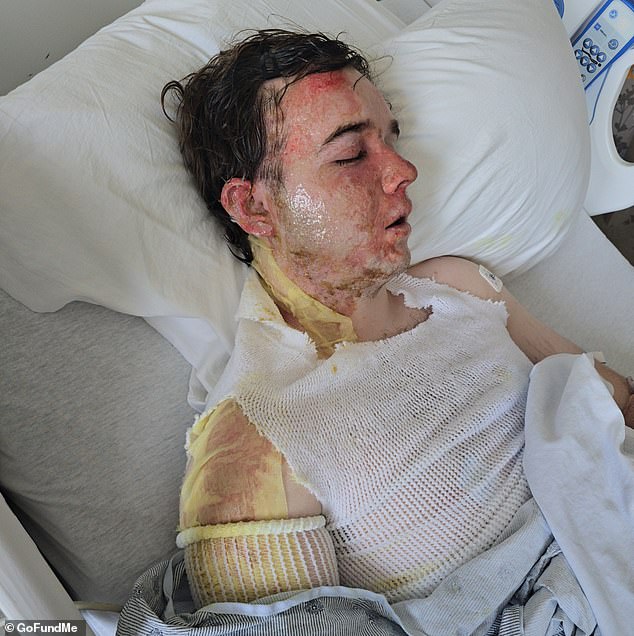 McDonald's Manager Suffers Severe Burns After Coworker Throws Scalding Oil