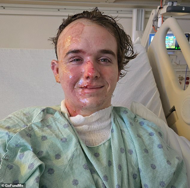 McDonald's Manager Suffers Severe Burns After Coworker Throws Scalding Oil