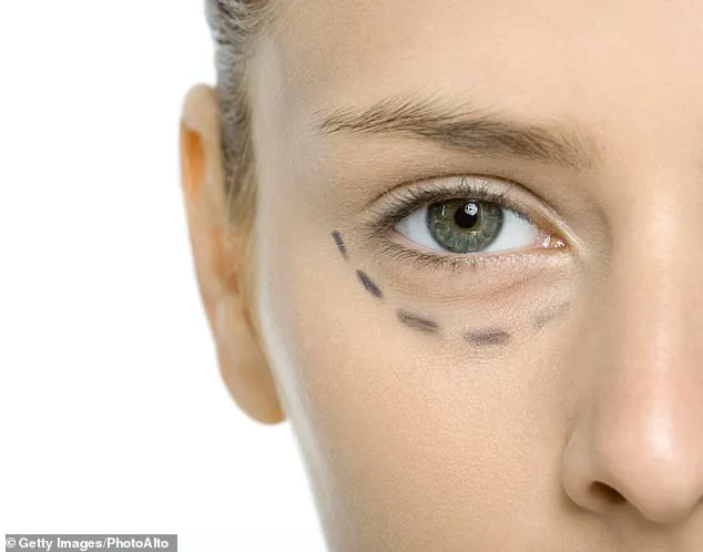Young Women Turn to Eyelid Surgery for Subtle Facial Rejuvenation