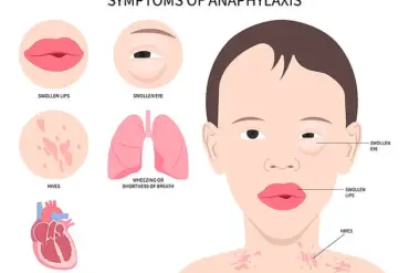 Rapid Expansion of Venomous Asian Needle Ant Sparks Alarms Across 19 US States