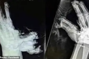 Fourth of July Fireworks: New Images Reveal Shocking Hidden Dangers in X-Rays of Life-Changing Injuries