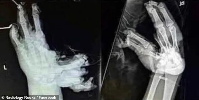 Fourth of July Fireworks: New Images Reveal Shocking Hidden Dangers in X-Rays of Life-Changing Injuries