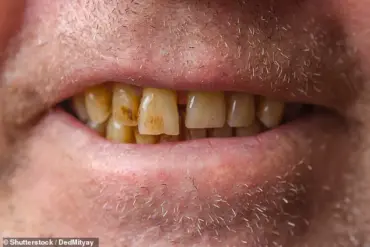 From Stains to Serious Health Risks: How Dental Issues Can Signal Wider Health Problems